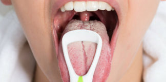 How to Treat White Tongue and Make It Healthy
