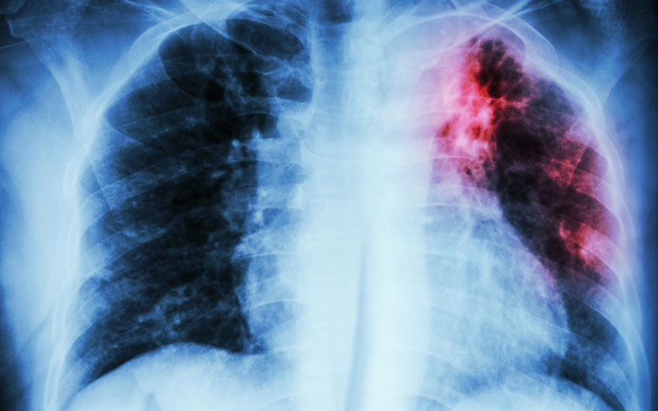 TB (Tuberculosis)