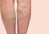 8 of the Best Ways to Treat Varicose Veins at Home
