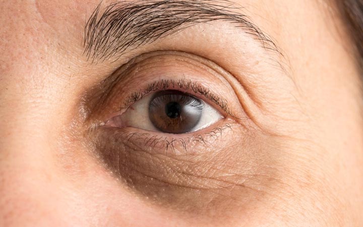 How to Get Rid of Dark Circles Under the Eyes Naturally