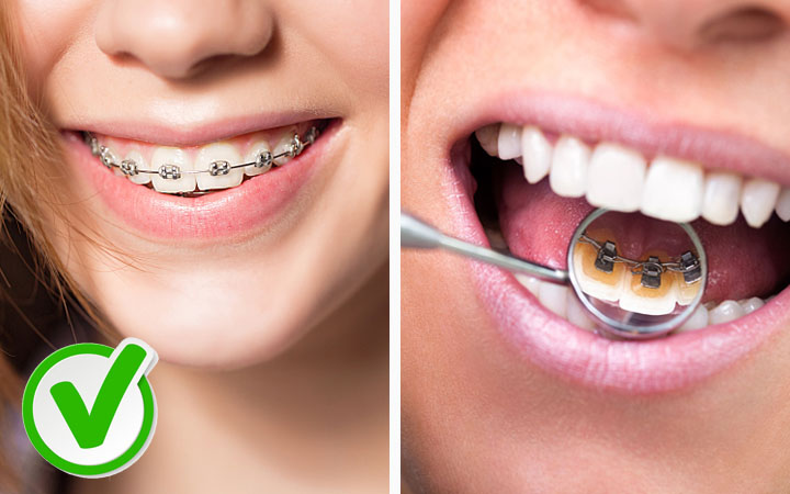 You Think You Are Too Old For Dental Braces