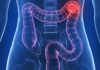 5 Hidden Signs of Colon Cancer that You Need to Know