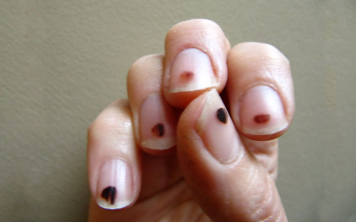 Changes to your fingernails.
