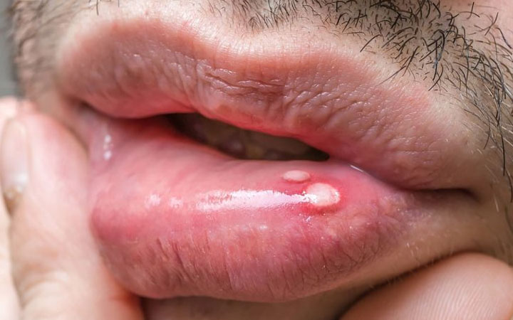 Mouth sores or pain