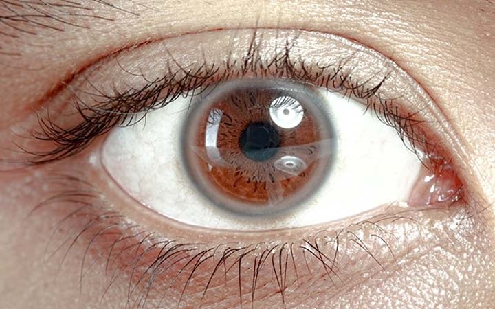 A White Circle Around The Iris Of The Eyes