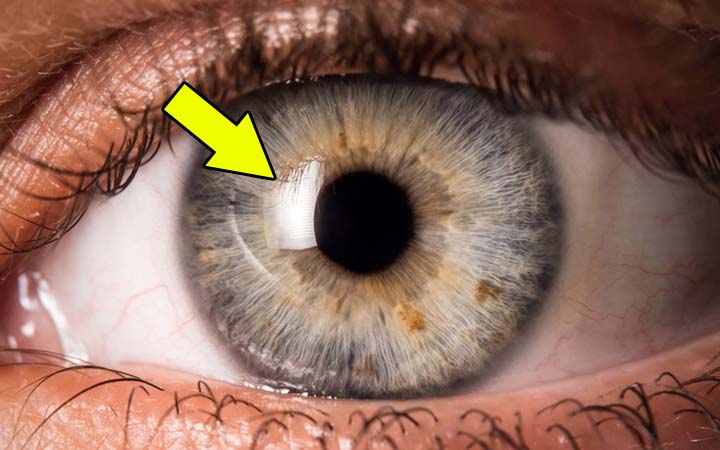 A White Visible Spot On The Corner Of The Eyes